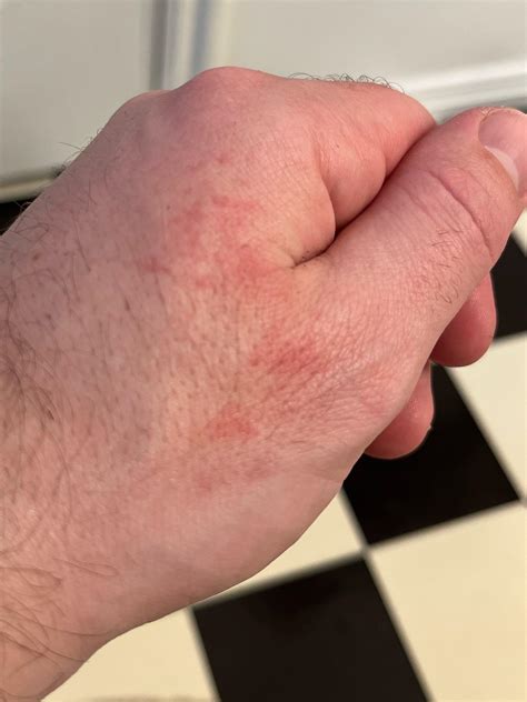 Does this look like I’m forming the rash? Or is it just dry skin? : r