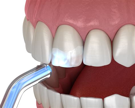 Teeth Bonding: What To Expect & Dental Bonding Cost