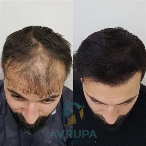 before and after photos of hair transplant 9