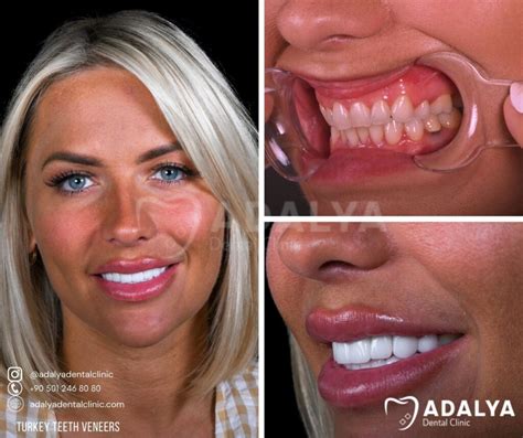 Turkey Teeth Veneers - Affordable Dental Veneer Price in Antalya