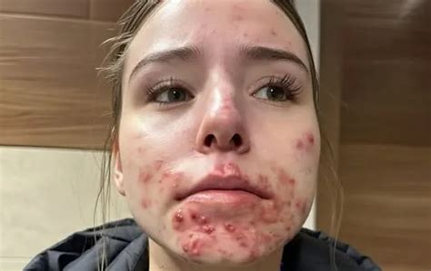 Unlocking the Mystery: The Surprising Triggers Behind Facial Acne in Specific Zones - Hunter Games Magazine