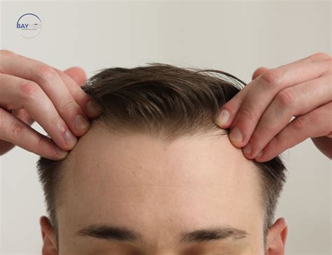 Early Signs of Hair Loss You Shouldn't Ignore - BayMed Hair | St ...