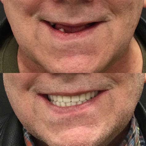 Memphis Dentures and Implants