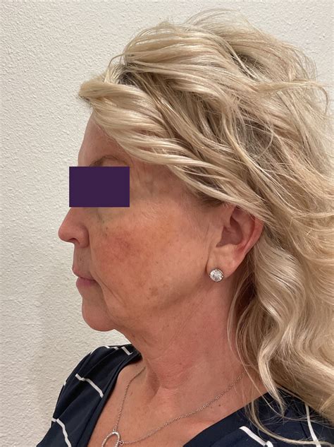 Case 4105 - Facial Fillers Before and After Photo Gallery | Sarasota