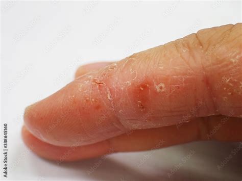 dyshidrotic eczema  finger close  stock photo adobe stock