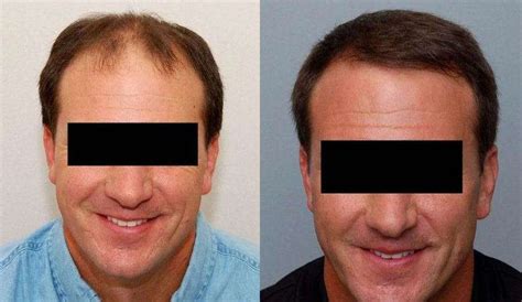 Do FUT Hair Transplants Leave Visible Scars?