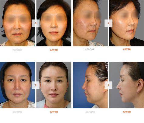 Mini facelift | VIP Plastic Surgery Korea