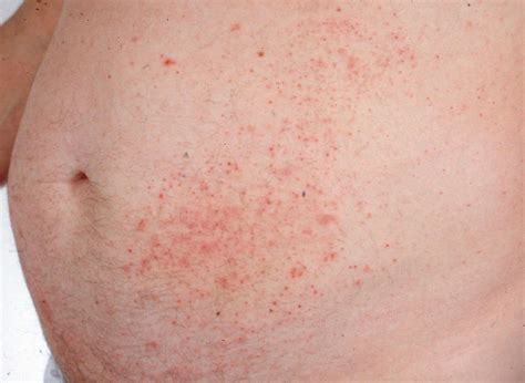 Dermatitis Herpetiformis Diagnosis With Skin Biopsy