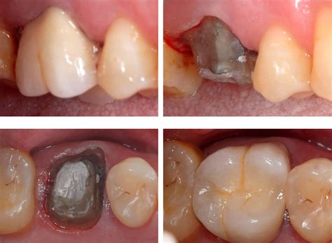 how to fix decaying teeth