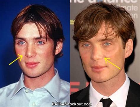 Cillian Murphy Plastic Surgery Comparison Photos