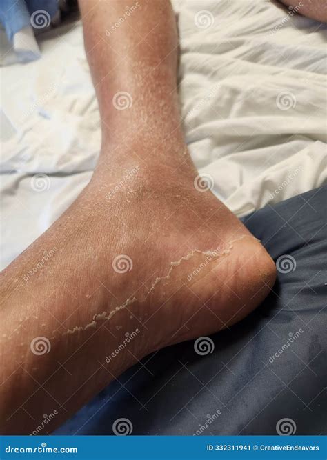 Pembroliimab Rash With Edema And Desquamation - Cancer Patient Stock