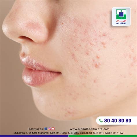 understanding acne vulgaris symptoms  treatments