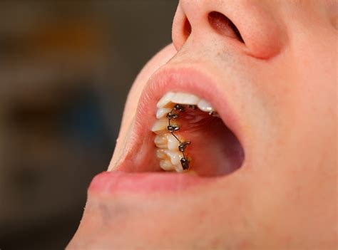invisible braces  teeth