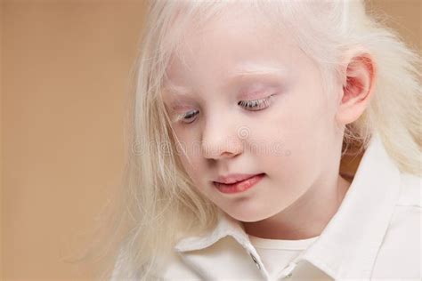 Albinism Syndrome Stock Photos - Free & Royalty-Free Stock Photos from ...