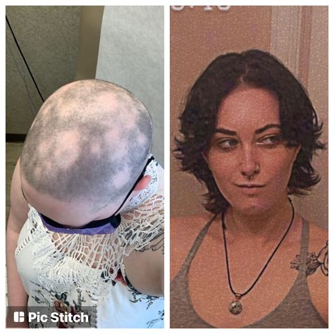 506 best r/alopecia_areata images on Pholder | Cicatricial Alopecia is