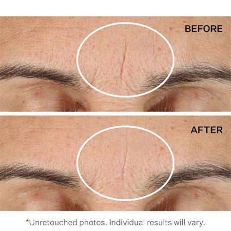 how to remove forehead wrinkles 14