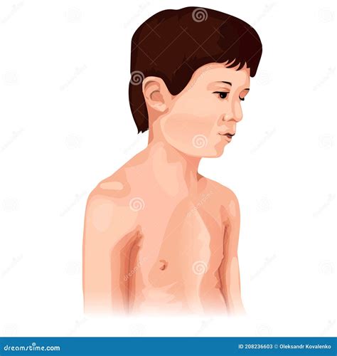 chest deformation disorder type pectus carinatum marfan syndrome
