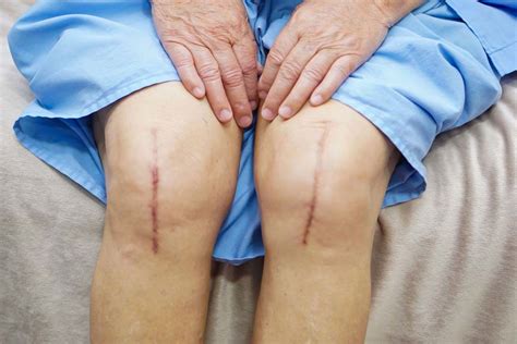 Knee Replacement - Types, Benefits, and Cost of Surgery in India ...