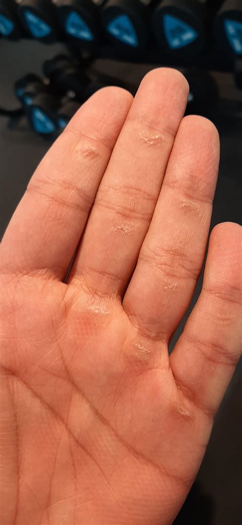How do i avoid finger callus ( mainly caused by overhead press and