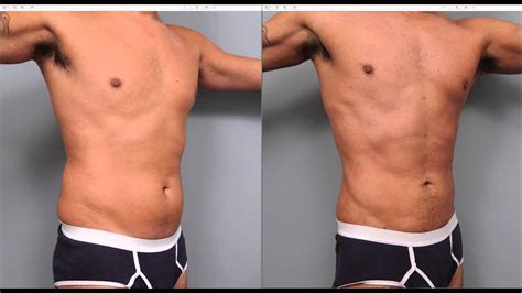 Lipo Pubiana Masculina Antes E Depois - The Benefits of Liposuction for Men | Dr. Sterry Explains - YouTube