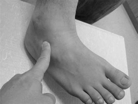 Inferior extensor retinaculum | Semantic Scholar