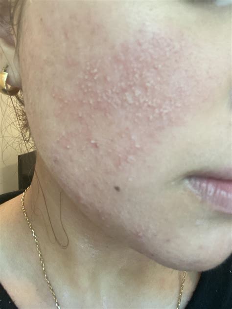 Please Help: tiny white bumps all over my face. I woke up this morning