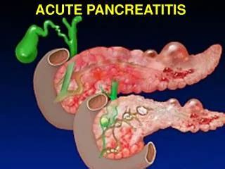 acute pancreatitis powerpoint    id