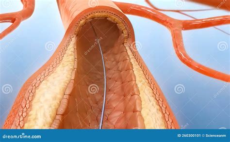Cardiac Catheterization, Stent into Body Stock Illustration ...