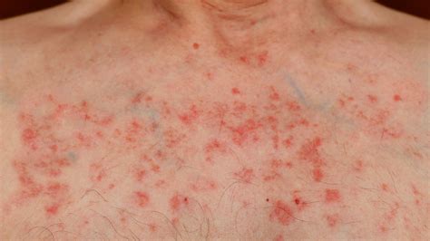 petechiae leukemia symptoms