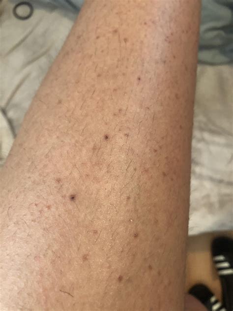 Blackheads Thighs at Randall Maupin blog