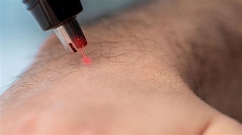 Depilacao A Laser Masculina - Depilação a laser masculina: antes e depois e preço