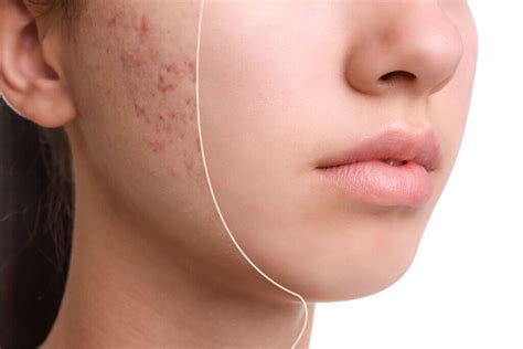 Skincare FAQs | Accutane Alternatives and Acne Treatment Options