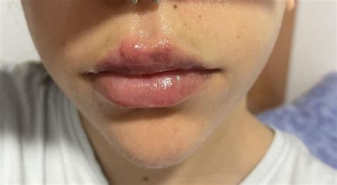 Bruises above my top lip after filler : r/PlasticSurgery