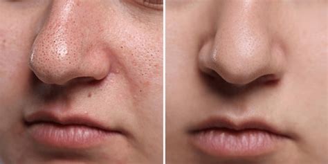 Unbelievable Blackhead Removal 2024: Before and After Pictures (Real People!) - k0cqzj3