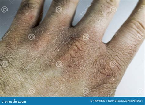 close view  dry  cracked hand knuckles skin problem stock image