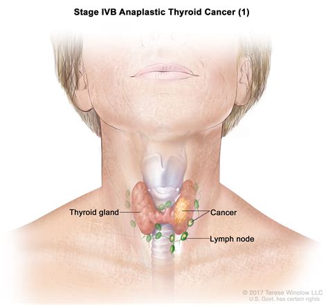 thyroid cancer treatment pdqpatient version nci