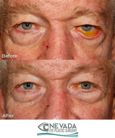 ectropion    photo gallery nevada eye plastic surgery