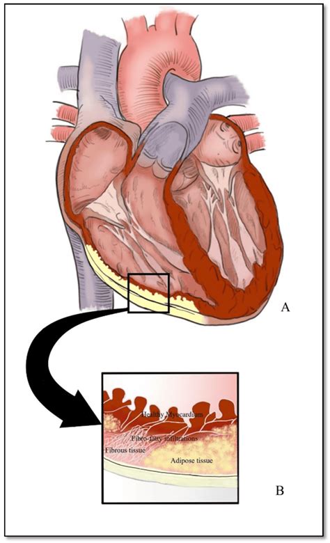 cardiopatia arritmogenica  ventriculo direito retoedu