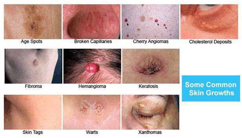 Benign Skin Growth Seborrheic Keratosis Vs. Melanoma | Vujevich