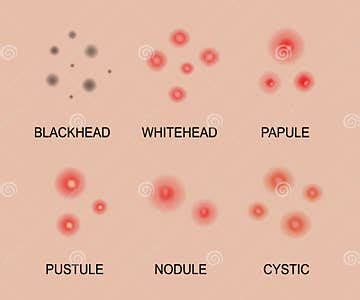 Different Types of Acne. Acne Skin Types. Blackheads, Whiteheads ...