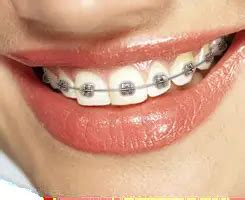 types  braces  san jose ca rafati orthodontics types  braces