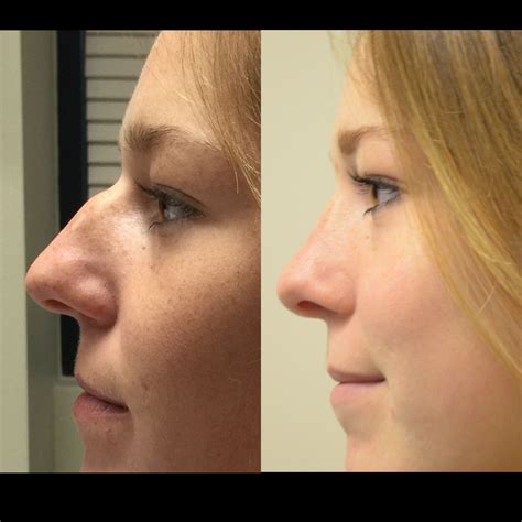 Pin by Juliana Ricci on nose | Nose job, Nose hair removal, Nose