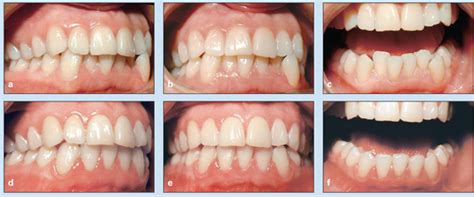 Orthodontic Management of Hypodontia | Pocket Dentistry