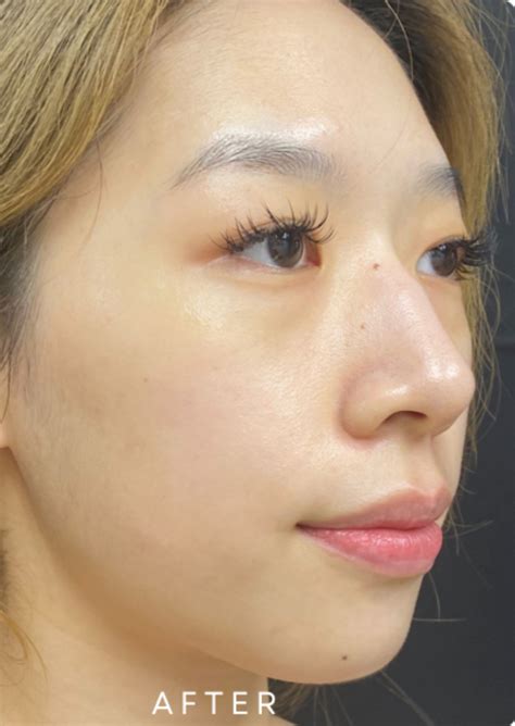 Hydrafacial Elite Treatment | Pure Cell - Beauty Clinic