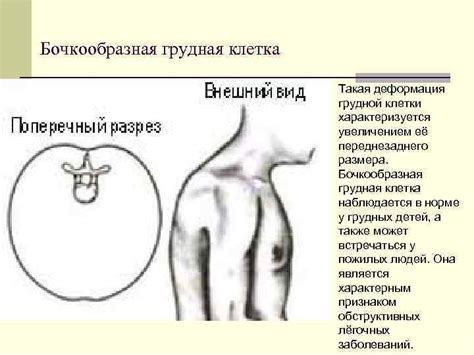 Осмотр грудной клетки Конституционные типы: n астеник