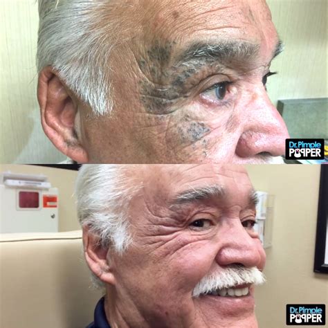 Dr Pimple Popper Bradley Leg Cancer 80