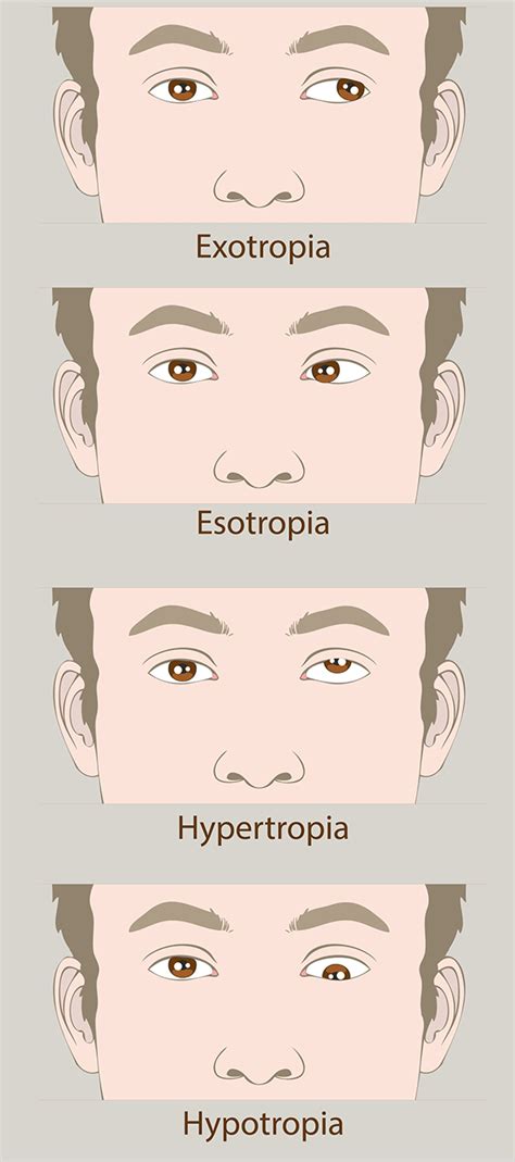 Amblyopia