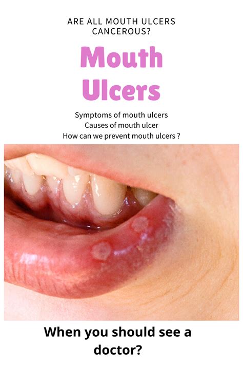 mouth ulcers zinc  carlos snyder blog