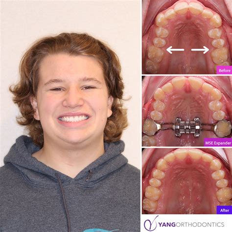 MSE - Yang Orthodontics