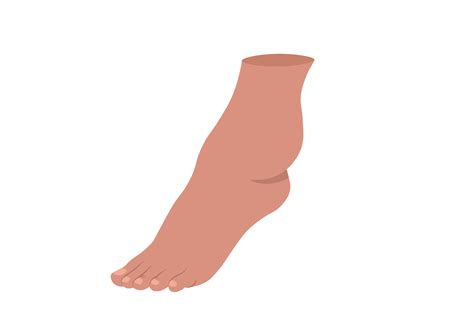 Edema Ankle Swelling